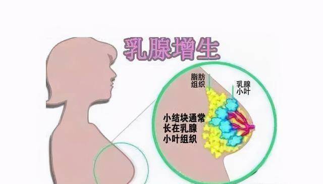 36岁女子查出乳腺癌，早期发现至关重要